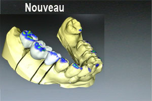 zircone-cad-cam